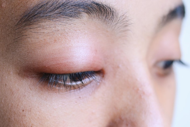 Close up of a boy with stye infection Eyelid abscess hordeolum in medical health