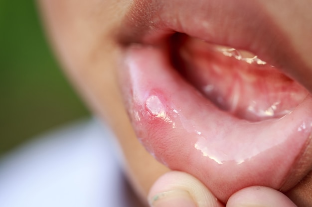 Close up Children with aphtha on lip