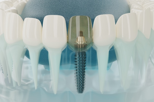 Primo piano componente di impianti dentali trasparente. rendering 3d.