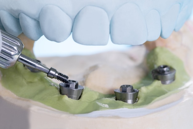 Close-up / Converteerbare abutment-componenten / Tandheelkundig implantaat tijdelijk abutment / Abutment-schroef.