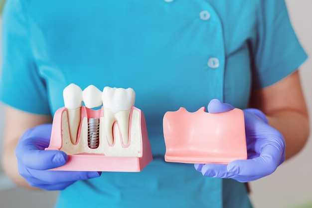 Close up of a Dental implant model. hands of the dentist holding implant