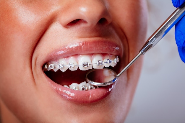 Close-up of a dentist checking braces with a dental mirror on the female patient.