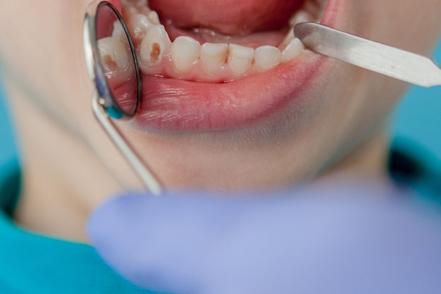 파란 장갑을 낀 조수와 함께 치과 의사의 손을 닫고 어린이 환자의 얼굴을 닫고 치아를 치료하고 있습니다