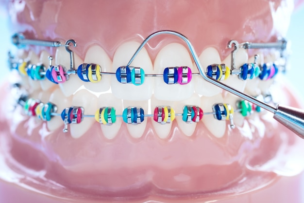Chiuda sugli strumenti del dentista e sul modello ortodontico - modello dei denti di dimostrazione delle varietà della parentesi ortodontica o del gancio