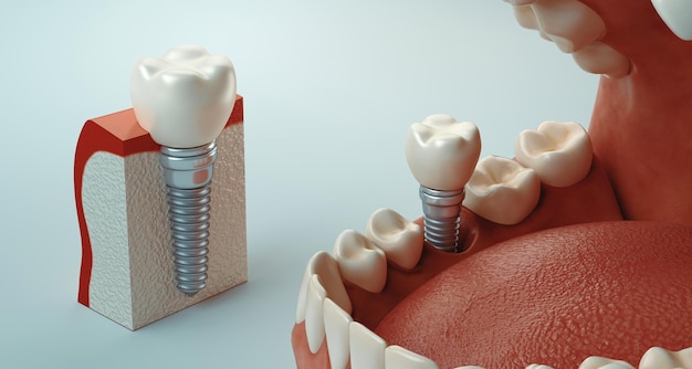 Photo close-up of dentures against gray background