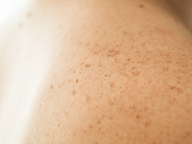 Close up detail of the bare skin on a man back with scattered moles and freckles. checking benign moles