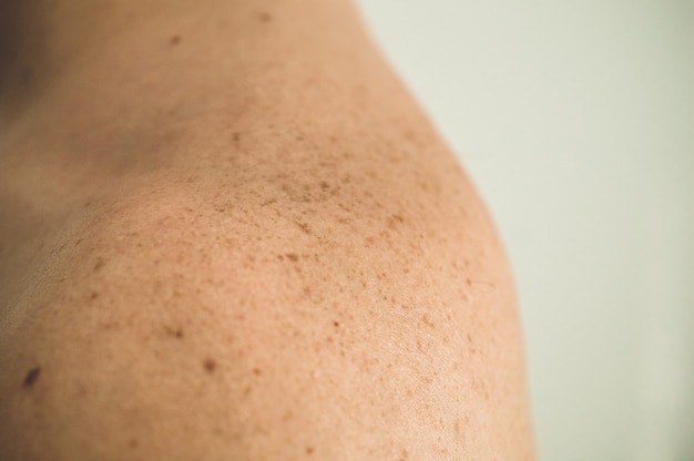 Close up detail of the bare skin on a man back with scattered moles and freckles. Checking benign moles