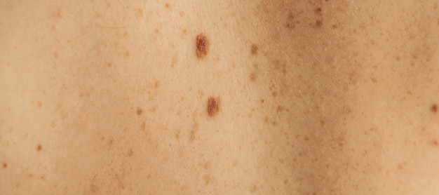 Close up detail of the bare skin on a man back with scattered moles and freckles. Checking benign moles