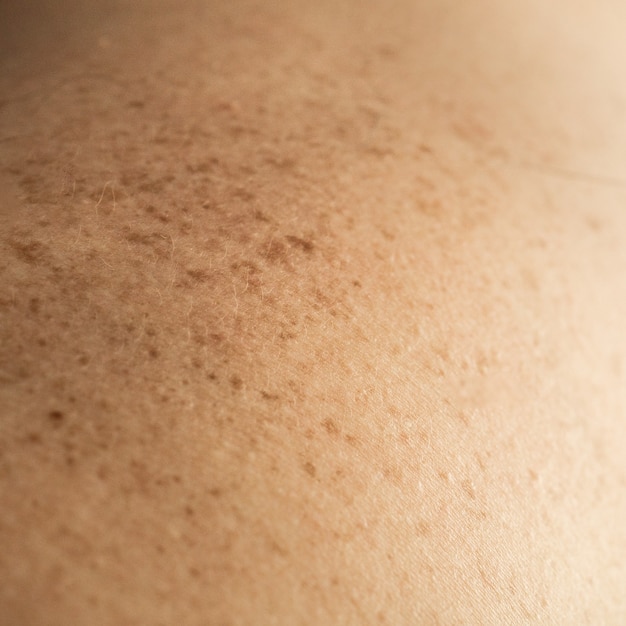 Close up detail of the bare skin on a man back with scattered moles and freckles. Checking benign moles