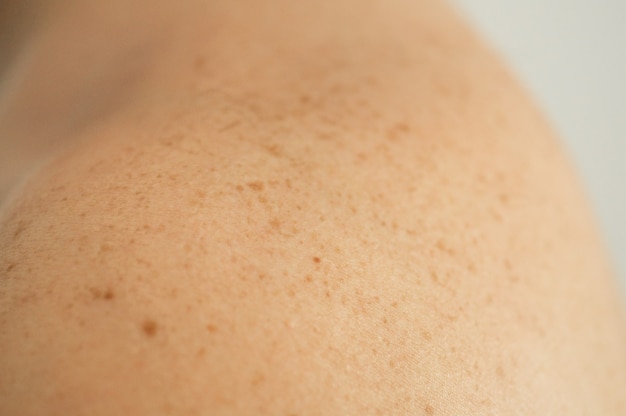 흩어져있는 두더지와 주근깨가있는 남자 등의 맨살 피부의 세부 사항을 닫습니다. 양성 점 확인