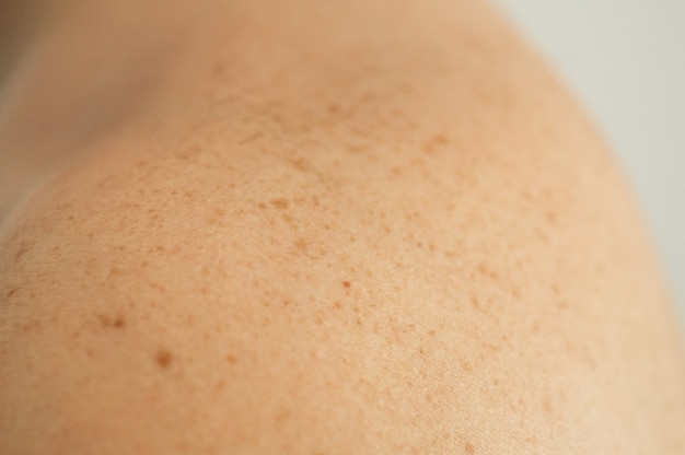 Close up detail of the bare skin on a man back with scattered moles and freckles. Checking benign moles