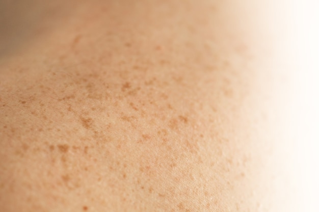 Close up detail of the bare skin on a man back with scattered moles and freckles. Checking benign moles