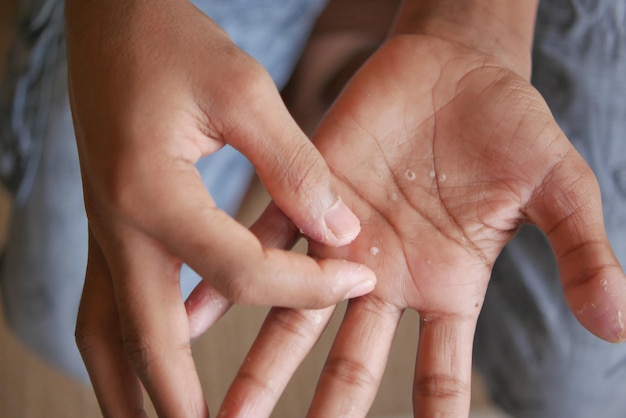 Close up of Dry cracked skin of a men39s hand