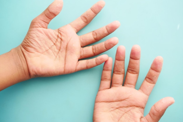 Close up of Dry cracked skin of a men39s hand