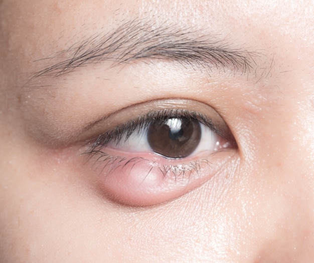 Photo close up of eyelid abscess (stye, hordeolum)