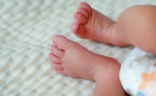 Close-up feet of a newborn with peeling skin.