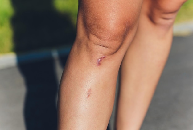 Photo close up of female knee with a scar