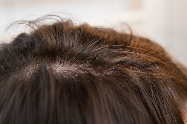 Close up on hair with dandruff