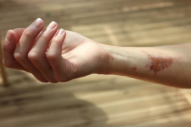 Photo close-up of hand with wound