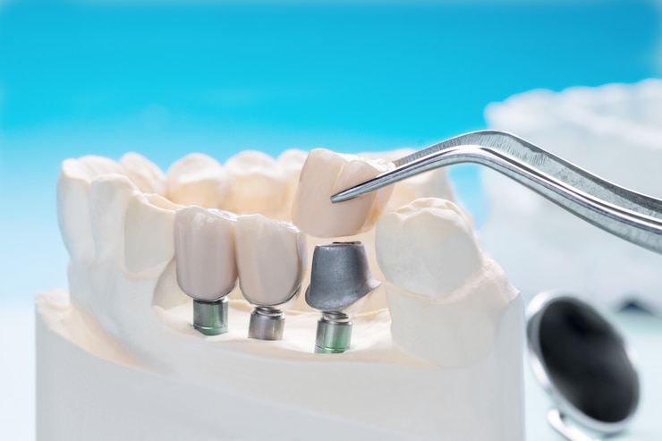 Close up Implan model tooth support fix bridge implan and crown.