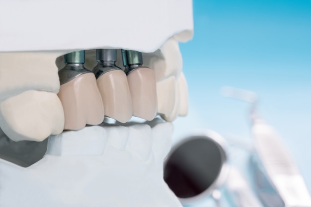 Фото Закройте модель имплантата, зубная опора фиксирует мостовой имплант и коронку.