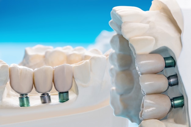 Photo close up implant model tooth support fix bridge implant and crown.