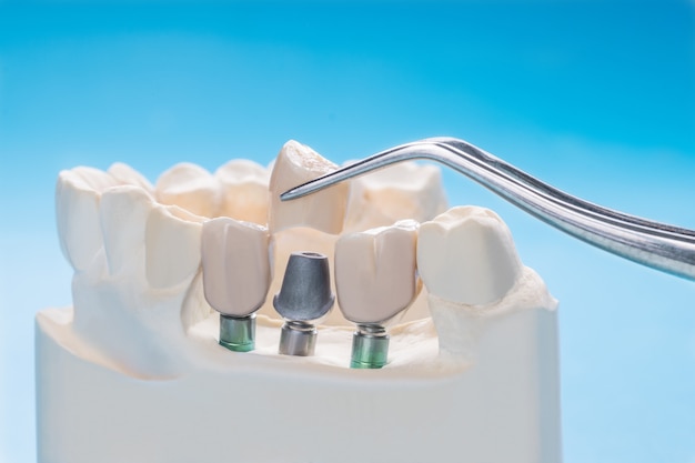 Close up Implant model tooth support fix bridge implant and crown.