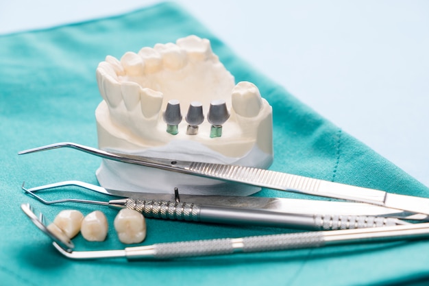 Close up Implant model tooth support fix bridge implant and crown.