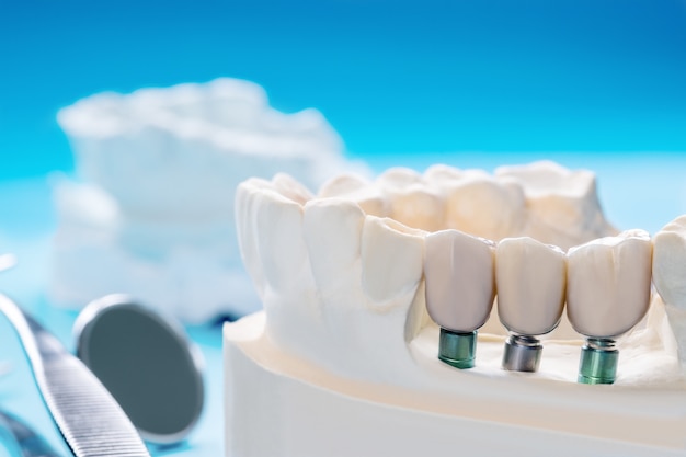 Close up Implant model tooth support fix bridge implant and crown.