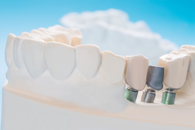 Close up Implant model tooth support fix bridge implant and crown.