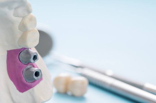 Close-up / implantaatprothetiek of prothese / tandkroon en brug implantaat tandheelkundige apparatuur en model express fix restauratie.