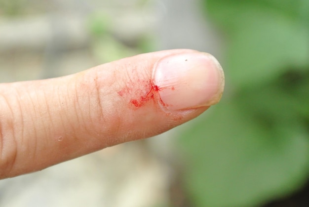 Close-up of injured finger