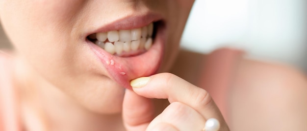 Photo close up on the lip with aphthous stomatitis