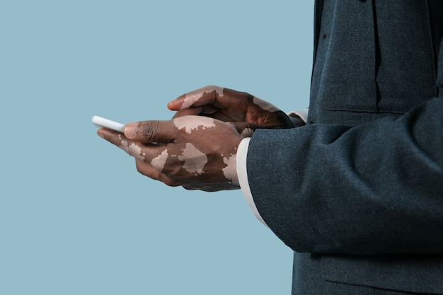 Close up of male hands with vitiligo pigments isolated on blue background. Special skin