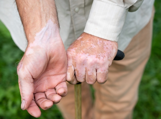 Chiuda in su delle mani maschile con pigmenti di vitiligine all'aperto