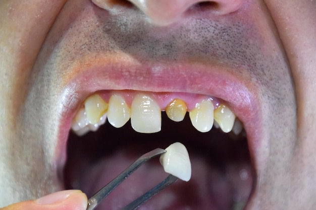 Photo close-up of man holding teeth