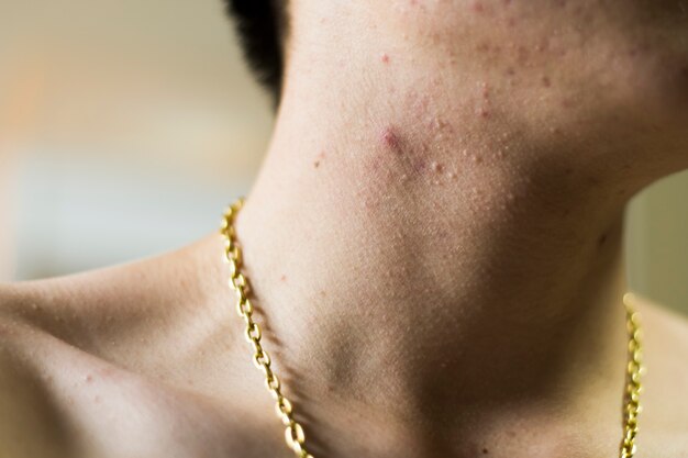 Primo piano di un uomo che indossa una collana d'oro con molta acne.