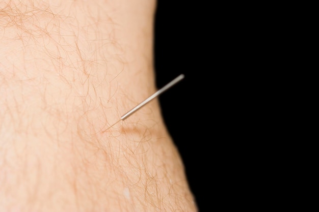 close-up of man with acupuncture needles on hand against black background