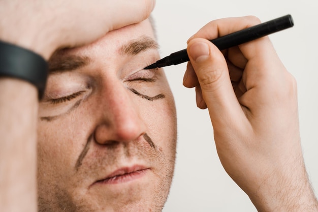 Close-up mannelijke ooglidcorrectie voor man markup op het gezicht vóór plastische chirurgie operatie voor het wijzigen van de oogregio in medische kliniek