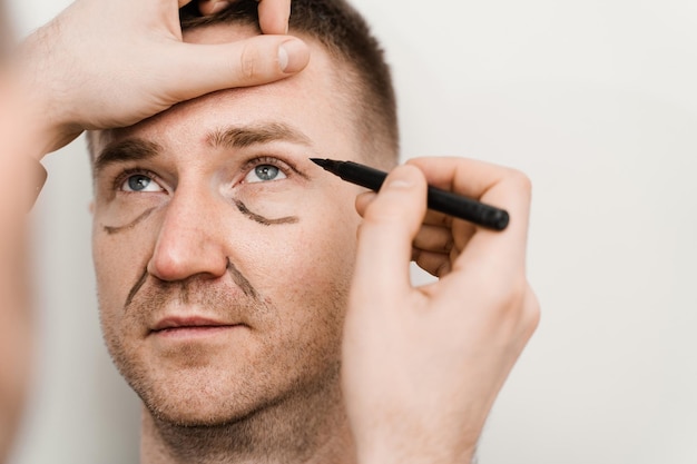 Close-up mannelijke ooglidcorrectie voor man markup op het gezicht vóór plastische chirurgie operatie voor het wijzigen van de oogregio in medische kliniek