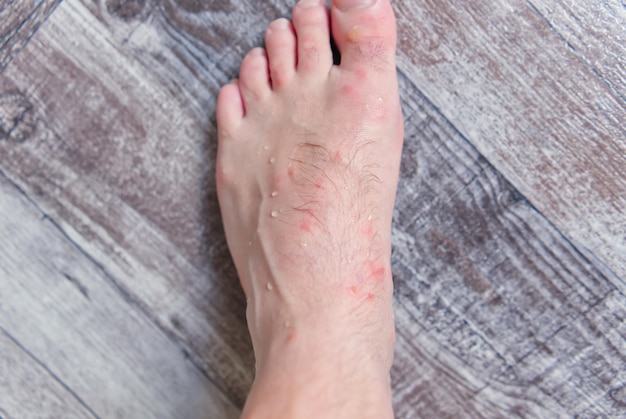 Close up on many mosquito bites on men\'s foot skin