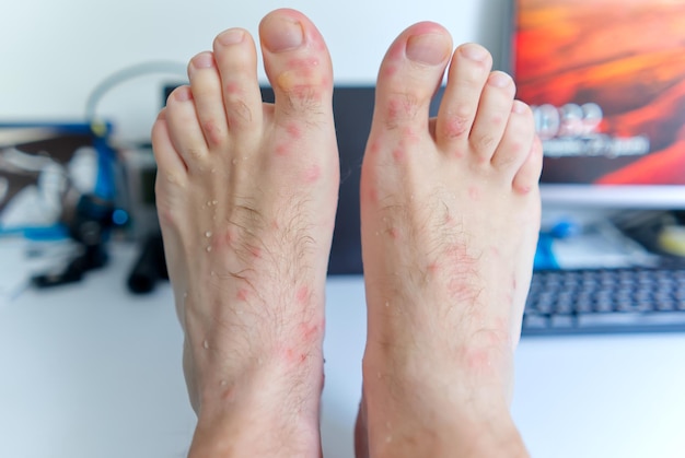 Close up on many mosquito bites on men's foot skin