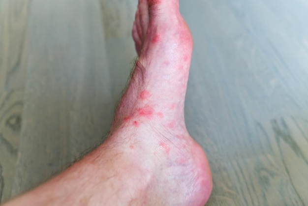 Close up on many mosquito bites on men\'s foot skin