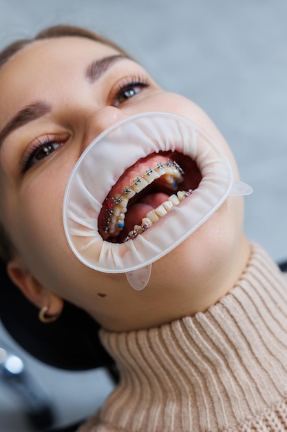 Photo close-up of mouth and teeth with metal braces. orthodontic dental treatment