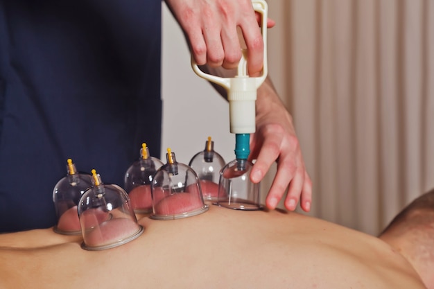 Close-up for multiple vacuum cups, medical cupping therapy on human body. Doctor with cups for patient, therapy. Wellness, health injury rehabilitation concept. Alternative medicine. Copy space