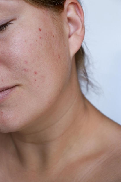 close-up natuurlijke vrouw slechte acne huid met littekens