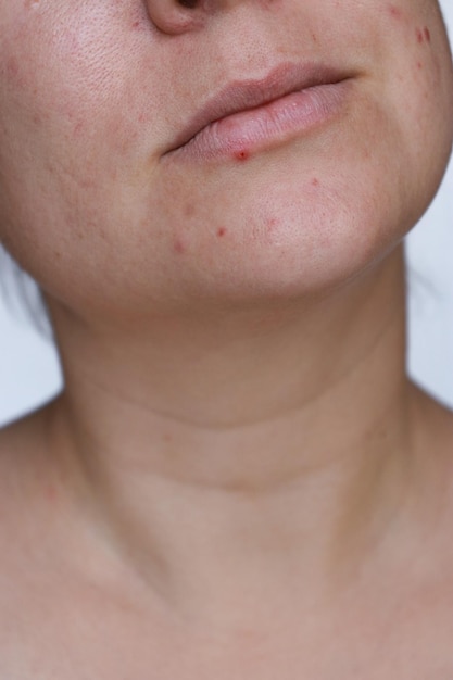 close-up natuurlijke vrouw slechte acne huid met littekens