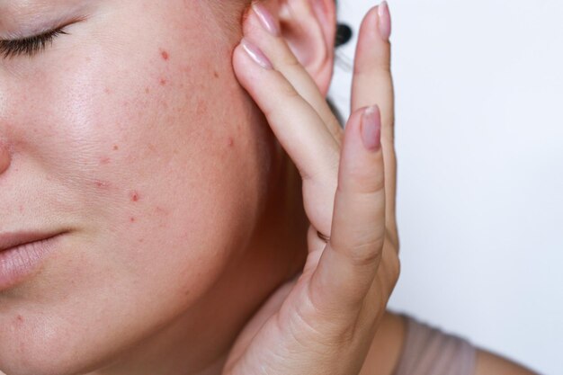 close-up natuurlijke vrouw slechte acne huid met littekens