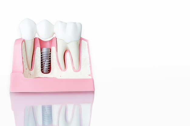写真 歯科インプラントモデルのクローズアップ。白色の背景。