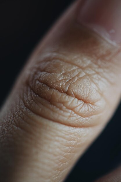 사진 절단 된 엄지손가락의 클로즈업